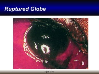 Globe Rupture Memory Note Craniofacial trauma, Diagnosis, Therapy, Management | PPT