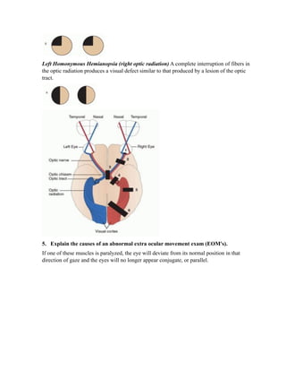 Left Homonymous Hemianopsia (right optic radiation) A complete interruption of fibers in
the optic radiation produces a visual defect similar to that produced by a lesion of the optic
tract.




5. Explain the causes of an abnormal extra ocular movement exam (EOM's).
If one of these muscles is paralyzed, the eye will deviate from its normal position in that
direction of gaze and the eyes will no longer appear conjugate, or parallel.
 