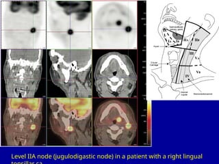Head and Neck AIIMS nuclear medicine department | PPT