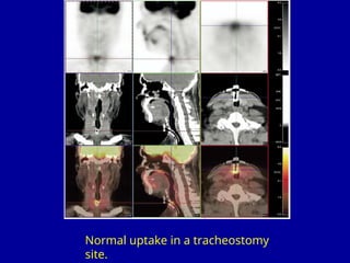 Head and Neck AIIMS nuclear medicine department | PPT