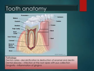 Tooth anatomy
Pathology
Dental caries –decalcification & destruction of enamel and dentin
Dental abscess – infection at the root apex with pus collection
Gingivitis – inflammation of gingiva
 