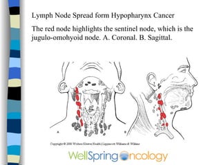 Head And Neck Cancer PPT Head And Neck Cancer PPT