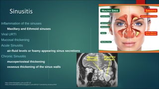 Sinusitis
Inflammation of the sinuses
Maxillary and Ethmoid sinuses
Viral URTI
Mucosal thickening
Acute Sinusitis
air-fluid levels or foamy appearing sinus secretions
Chronic Sinusitis
mucoperiosteal thickening
osseous thickening of the sinus walls
http://shentherapies.com.au/521-2/
http://rhaudhahbinafsha.blogspot.com/2010/11/anatomy-of-sinus.html
 