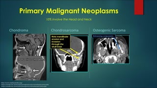Primary Malignant Neoplasms
Chondroma Chondrosarcoma Osteogenic Sarcoma
http://www.radiopaedia.org/
https://medicine.uiowa.edu/iowaprotocols/chondrosarcoma-rads
https://medicine.uiowa.edu/iowaprotocols/osteosarcoma-rads
10% involve the Head and Neck
 