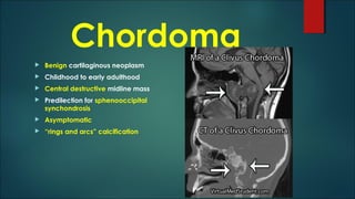 Chordoma
 Benign cartilaginous neoplasm
 Childhood to early adulthood
 Central destructive midline mass
 Predilection for sphenooccipital
synchondrosis
 Asymptomatic
 “rings and arcs” calcification
 