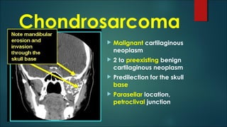 Chondrosarcoma
 Malignant cartilaginous
neoplasm
 2 to preexisting benign
cartilaginous neoplasm
 Predilection for the skull
base
 Parasellar location,
petroclival junction
 
