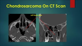 Chondrosarcoma On CT Scan
soft tissue mass
 