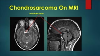 Chondrosarcoma On MRI
Lobulated mass
 