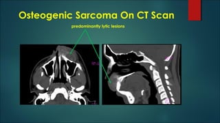 Osteogenic Sarcoma On CT Scan
predominantly lytic lesions
 