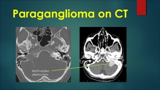 Paraganglioma on CT
Moth-eaten
destruction
 