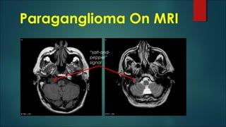Paraganglioma On MRI
“salt-and-
pepper”
signal
 
