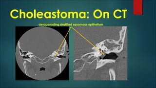 Choleastoma: On CT
desquamating stratified squamous epithelium
 