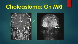 Choleastoma: On MRI
 