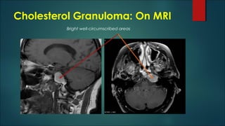 Cholesterol Granuloma: On MRI
Bright well-circumscribed areas
 