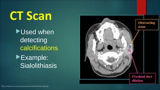 CT Scan
Used when
detecting
calcifications
Example:
Sialolithiasis
https://medicine.uiowa.edu/iowaprotocols/sialolithiasis-radiology
 