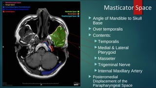 Masticator Space
 Angle of Mandible to Skull
Base
 Over temporalis
 Contents:
 Temporalis
 Medial & Lateral
Pterygoid
 Masseter
 Trigeminal Nerve
 Internal Maxillary Artery
 Posteromedial
Displacement of the
Parapharyngeal Space
 