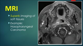 MRI
Superb imaging of
soft tissues
Example:
Nasopharyngeal
Carcinoma
 