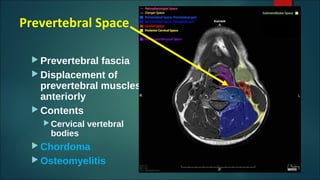 Prevertebral Space
 Prevertebral fascia
 Displacement of
prevertebral muscles
anteriorly
 Contents
 Cervical vertebral
bodies
 Chordoma
 Osteomyelitis
 