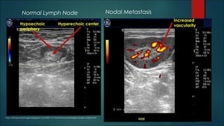 Normal Lymph Node Nodal Metastasis
Hyperechoic centerHypoechoic
periphery
Increased
vascularity
http://ultrasound-images.blogspot.com/2011/11/normal-and-enlarged-lymph-nodes.html
 