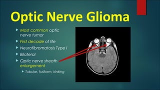 Optic Nerve Glioma
 Most common optic
nerve tumor
 First decade of life
 Neurofibromatosis Type I
 Bilateral
 Optic nerve sheath
enlargement
 Tubular, fusiform, kinking
 