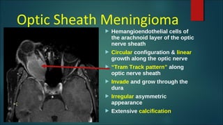 Optic Sheath Meningioma
 Hemangioendothelial cells of
the arachnoid layer of the optic
nerve sheath
 Circular configuration & linear
growth along the optic nerve
 “Tram Track pattern” along
optic nerve sheath
 Invade and grow through the
dura
 Irregular asymmetric
appearance
 Extensive calcification
 
