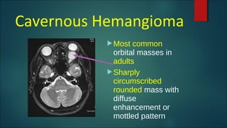 Cavernous Hemangioma
Most common
orbital masses in
adults
Sharply
circumscribed
rounded mass with
diffuse
enhancement or
mottled pattern
 