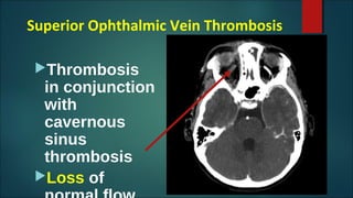 Superior Ophthalmic Vein Thrombosis
Thrombosis
in conjunction
with
cavernous
sinus
thrombosis
Loss of
 