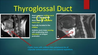 Thyroglossal Duct
Cyst
Most common midline neck
mass in young patients
Most common congenital
neck cyst
Typically located in the
midline
Anterior neck mass moving
with swallowing and
elevated on tongue
protrusion
Cystic mass with uniform thin peripheral rim of
capsular enhancement and occasional septations
 