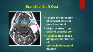 Branchial Cleft Cyst
 Failure of regression
of cervical sinus or
pouch remnant
 Majority arise from
second brachial cleft
 Painless neck mass
along anterior border
of
sternocleidomastoid
muscle
Well-circumscribed cystic lesion
 