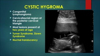 CYSTIC HYGROMA
 Congenital
lymphangioma
 Cervicofascial region at
the posterior cervical
triangle
 Most lesions present at
two years of age
 Turner Syndrome, Down
Syndrome
 Nuchal translucency
 