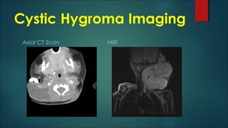 Cystic Hygroma Imaging
Axial CT Scan MRI
 