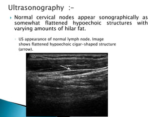 Normal cervical nodes appear sonographically as
somewhat flattened hypoechoic structures with
varying amounts of hilar fat.
◦ US appearance of normal lymph node. Image
shows flattened hypoechoic cigar-shaped structure
(arrow).
 