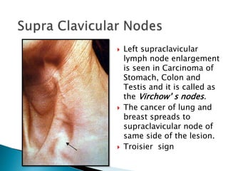  Left supraclavicular
lymph node enlargement
is seen in Carcinoma of
Stomach, Colon and
Testis and it is called as
the Virchow’ s nodes.
 The cancer of lung and
breast spreads to
supraclavicular node of
same side of the lesion.
 Troisier sign
 