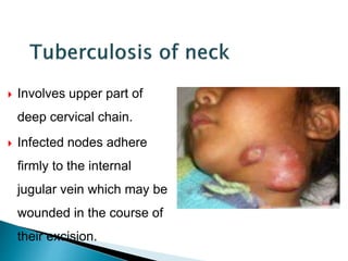  Involves upper part of
deep cervical chain.
 Infected nodes adhere
firmly to the internal
jugular vein which may be
wounded in the course of
their excision.
 