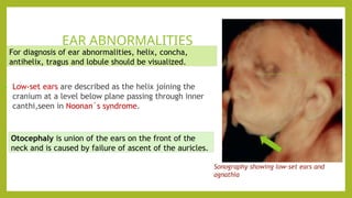 head and neck masses power point presentation | PPTX