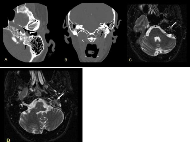 head-and-neck-paraganglioma-pptx