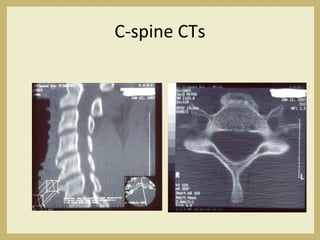C-spine CTs
 