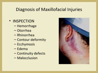 Diagnosis of Maxillofacial Injuries
• INSPECTION
– Hemorrhage
– Otorrhea
– Rhinorrhea
– Contour deformity
– Ecchymosis
– Edema
– Continuity defects
– Malocclusion
 