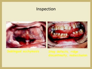 Inspection
Sublingual ecchymosis Step defects, ridge
discontinuity, malocclusion
 