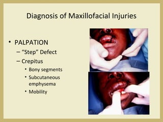 Diagnosis of Maxillofacial Injuries
• PALPATION
– “Step” Defect
– Crepitus
• Bony segments
• Subcutaneous
emphysema
• Mobility
 