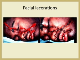 Facial lacerations
 