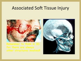 Associated Soft Tissue Injury
Remember to think in 3D
for there are always
other structures involved!
 