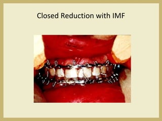 Closed Reduction with IMF
 