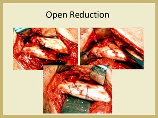 Open Reduction
 