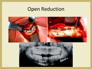 Open Reduction
 