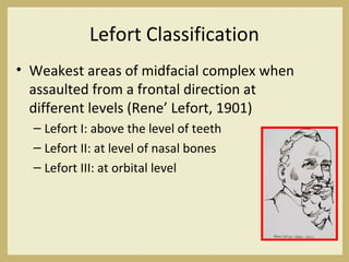 Lefort Classification
• Weakest areas of midfacial complex when
assaulted from a frontal direction at
different levels (Rene’ Lefort, 1901)
– Lefort I: above the level of teeth
– Lefort II: at level of nasal bones
– Lefort III: at orbital level
 