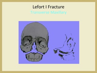 Lefort I Fracture
Transverse Maxillary
 