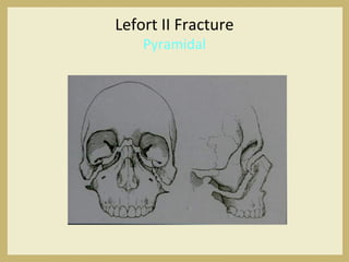 Lefort II Fracture
Pyramidal
 