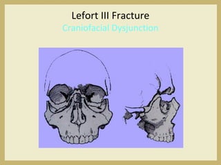 Lefort III Fracture
Craniofacial Dysjunction
 