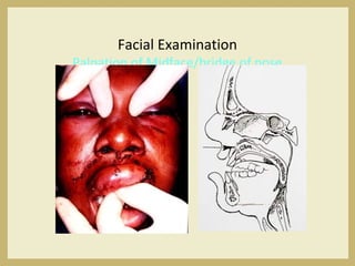 Facial Examination
Palpation of Midface/bridge of nose
 